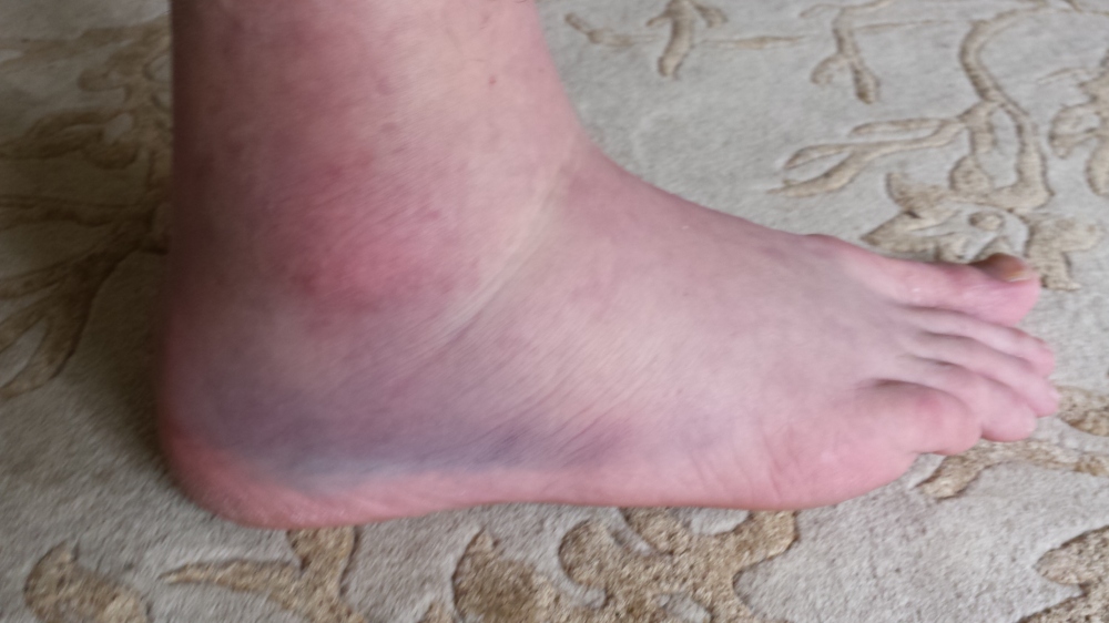 Rich Zaydel's Broken Ankle BJJ Injury